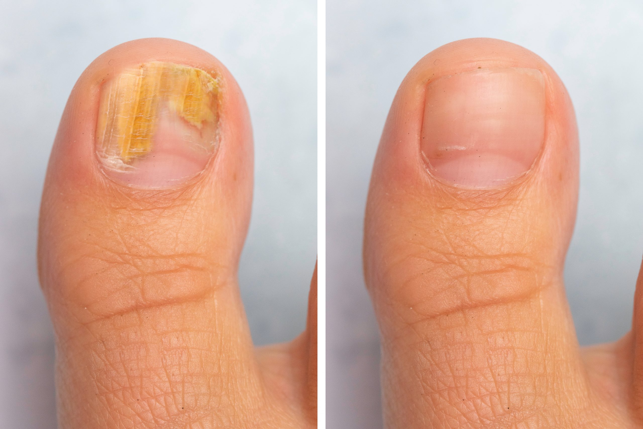 The connection between toenail fungus and diabetes
