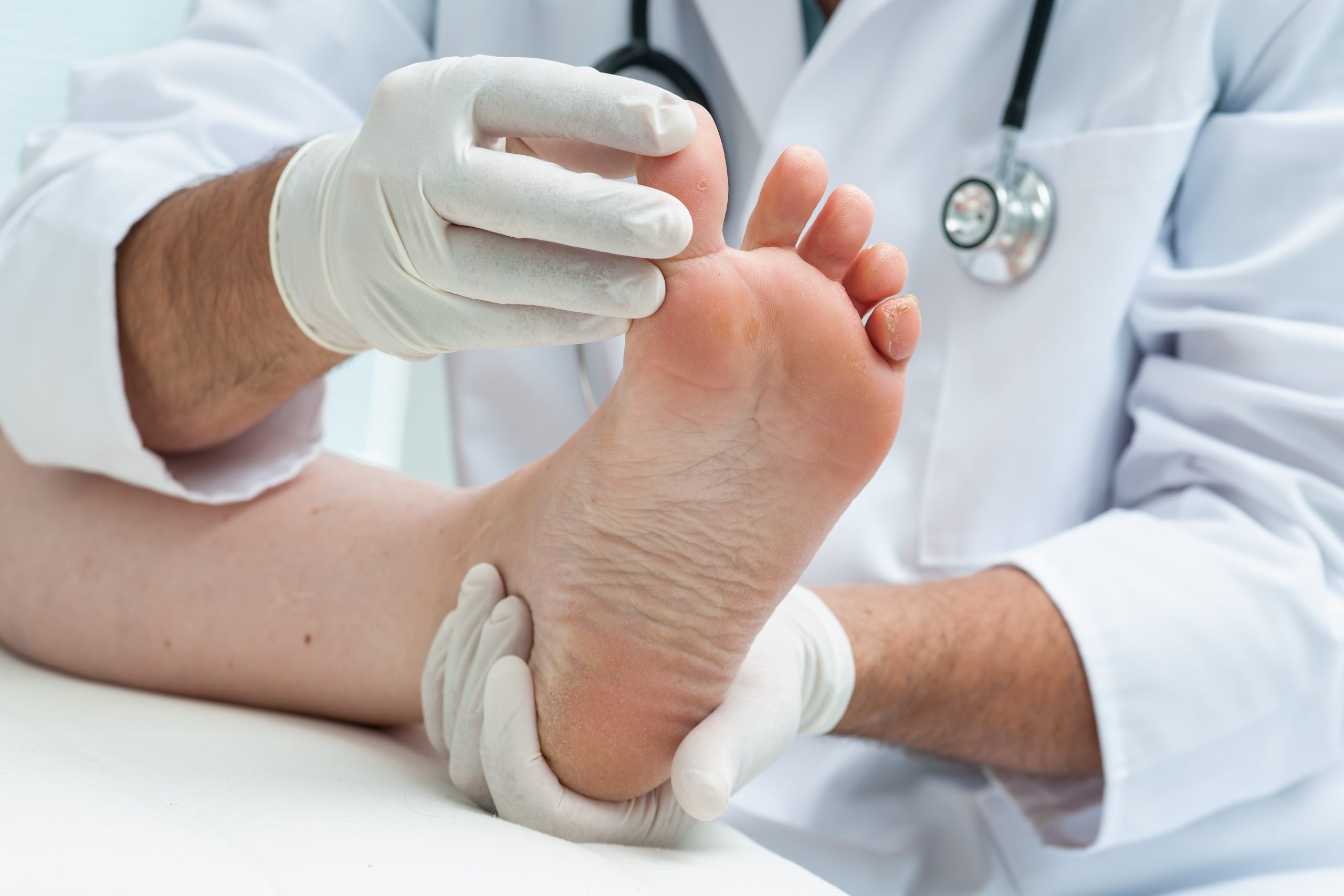The symptoms of toenail fungus and how to diagnose it